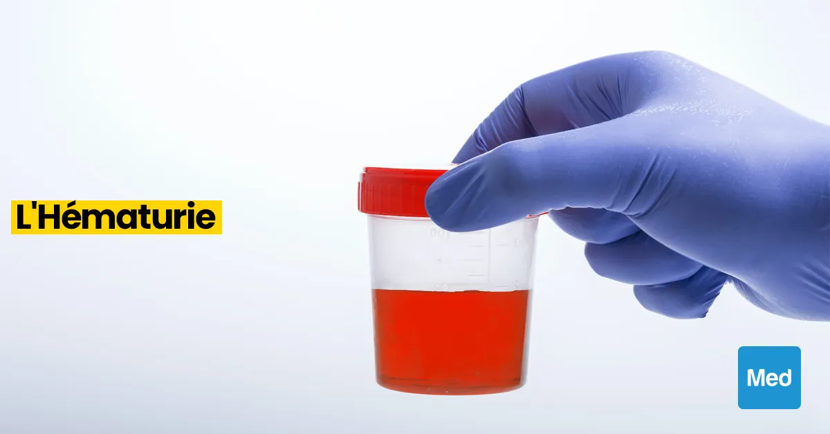 Comprendre l'Hématurie : Sang dans l'Urine, Causes et Préoccupations